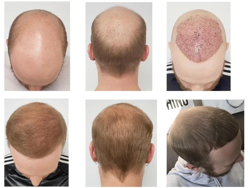 Minoxidil Topical and Hair Transplants: A Winning Combination